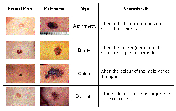 Skin Cancer Abcde Chart